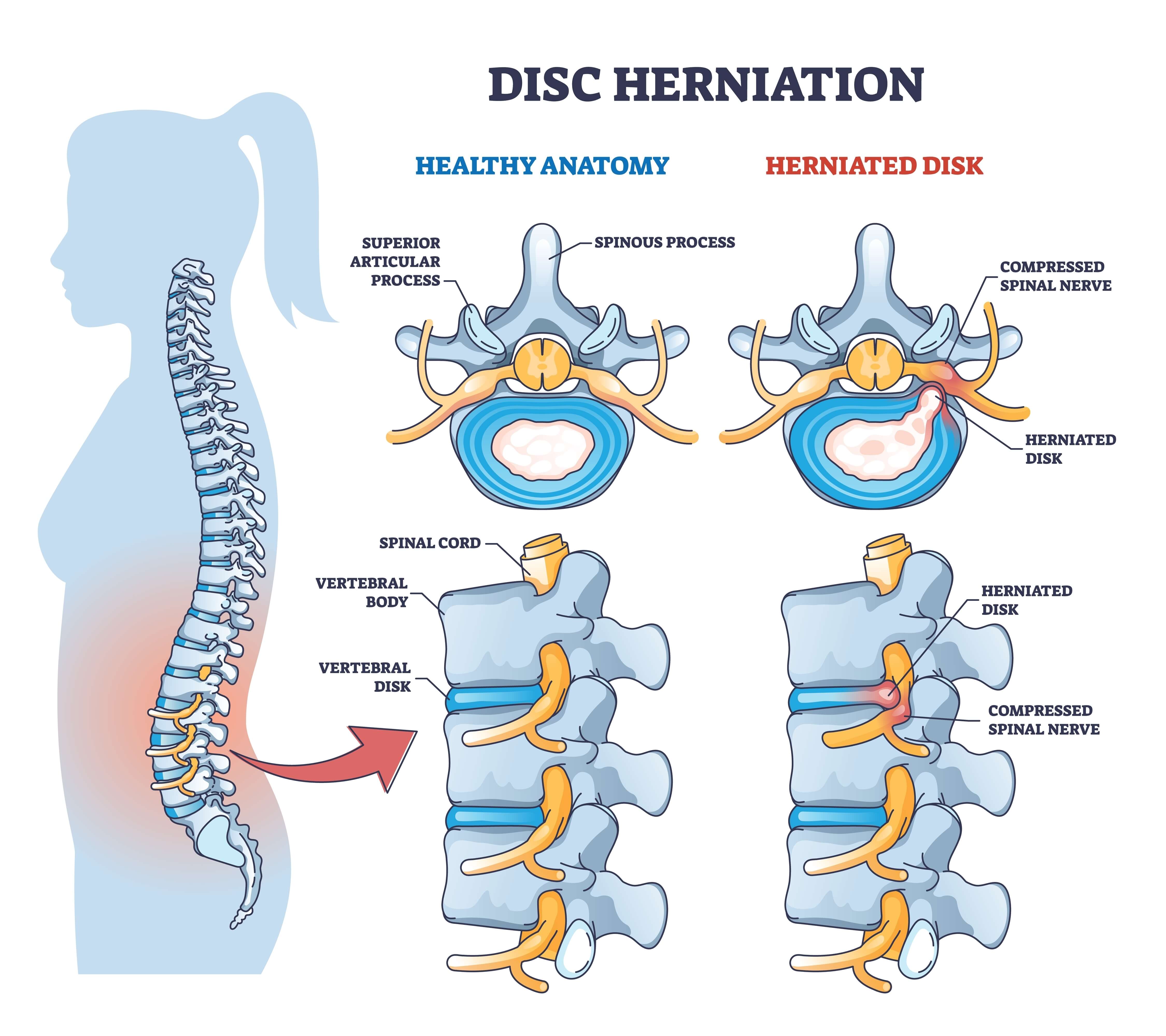 bulging-disc-compensation-claims